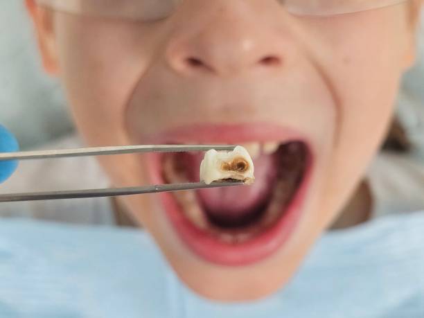 Best Chipped Tooth Repair Near Me  in Clark Mills, NY
